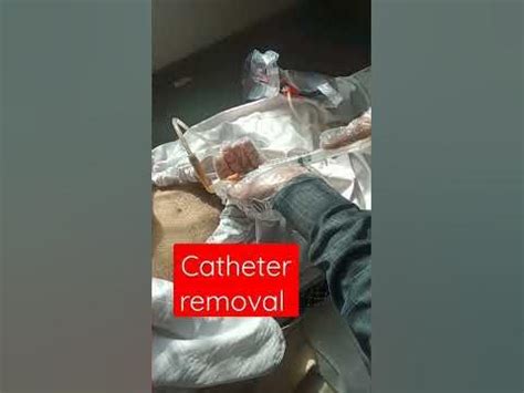 catheter removal - YouTube