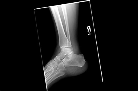 Case Study: Can You Diagnose the Weber Fracture? - Clinical Pain Advisor