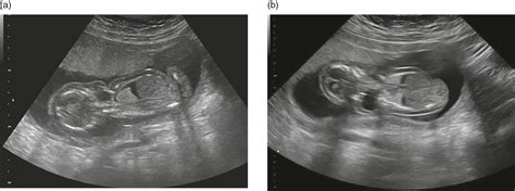 Hydrops Ultrasound