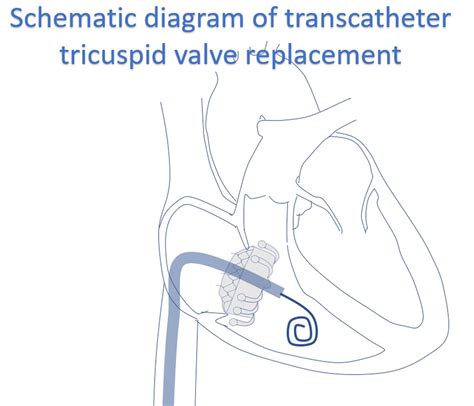 Transcatheter tricuspid valve replacement – All About Cardiovascular System and Disorders