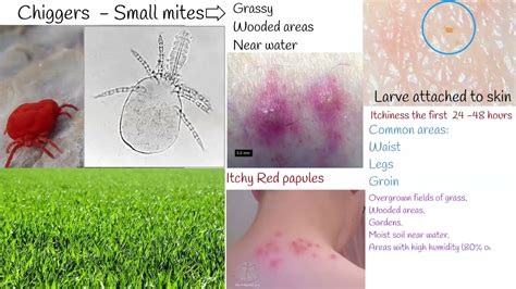 Chiggers bite - red bugs, harvest mites, symptoms and treatment. - YouTube