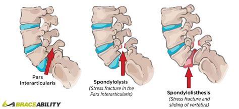 spondylolysis compared to spondylolisthesis and how the pars interarticularis controls spinal ...