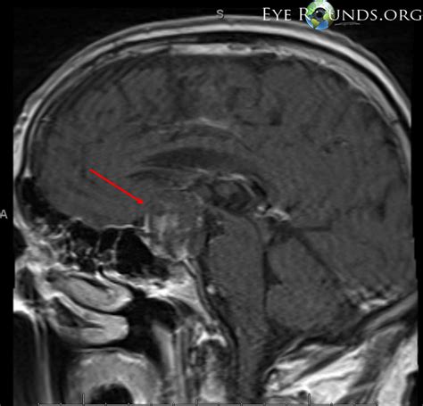 Pituitary Adenoma Causing Compression of the Optic Chiasm: The University of Iowa, Ophthalmology