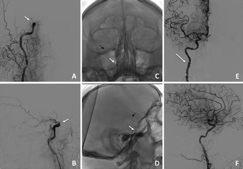 Acute right T-ICA occlusion at ophthalmic tract (with arrow in a and ...