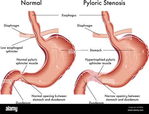 Lower Esophageal Sphincter Histology | The Best Porn Website