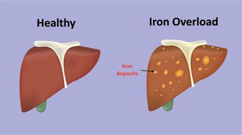 What Is Hemochromatosis? Causes, Symptoms, and Treatment