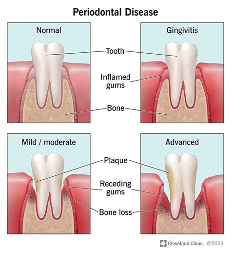 Periodontal disease - MEDizzy