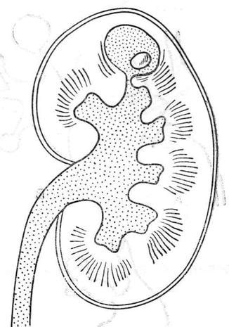 Diagnostics of Pelvicalyceal Diverticula | Radiology Key