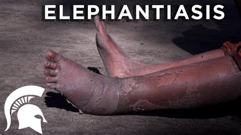 Elephantiasis Youtube