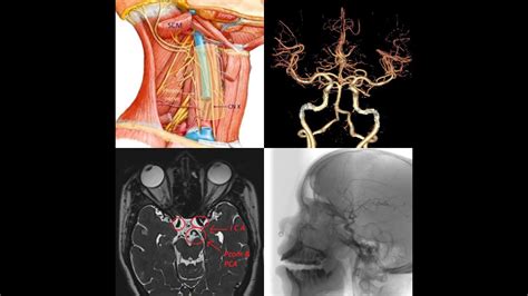 Part 1-INTERNAL CAROTID ARTERY.Clinical & Surgical anatomy,Real time Arteriography,MRI & CT ...