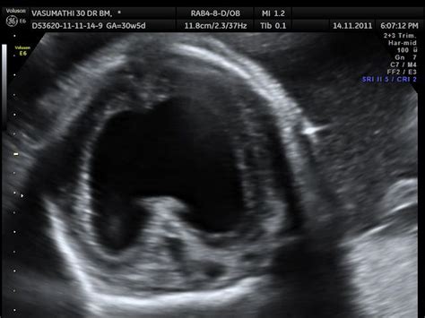 HOLOPROSENCEPHALY- ALOBAR | Looking Through a Transducer | Diagnostic ...