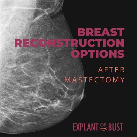 Breast Reconstruction Options After Mastectomy – Explant or Bust!