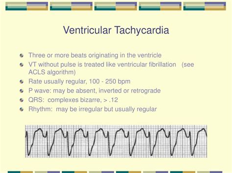 Ventricular Tachycardia Causes Diagnosis And Treatment