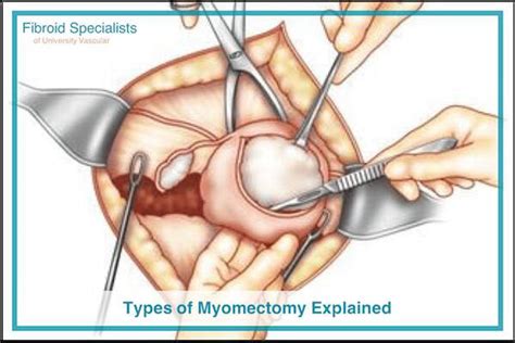 Types of Myomectomy: Hysteroscopic, Laparoscopic, Abdominal, & More