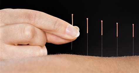 Acupuncture Improves Joint Pain in Breast Cancer Patients Taking ...