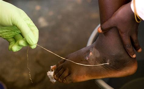 Guinea Worm Closer to Eradication as Cases Halve in a Year – Courthouse ...