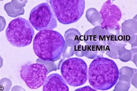 Acute Myeloid Leukemia | CheckRare