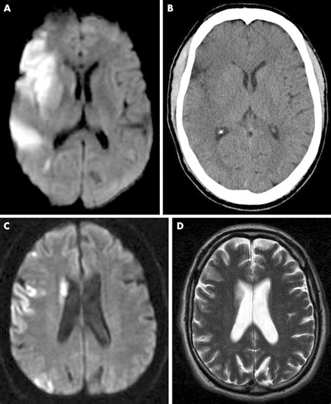 Imaging of acute stroke and transient ischaemic attack | Journal of ...