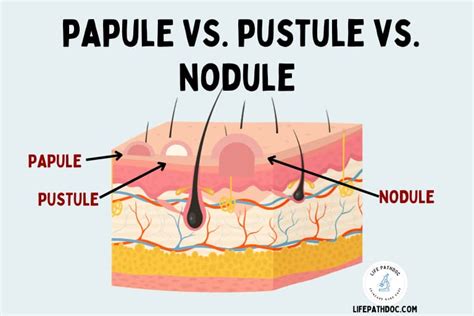 Papule vs Pustule vs Nodule: Pictures, Differences, and Causes