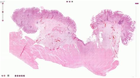 Peptic Ulcer - Histopathology - YouTube