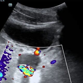 Color doppler applied to hyperechoic object demonstrating twinkle artifact. | Download ...