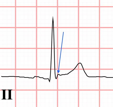 J point notching ECG