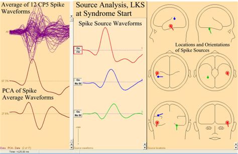 FMAER, Landau-Kleffner syndrome, CP5 spike source analysis. Source ...