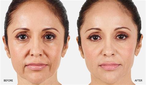 JUVEDERM-XC-BEFORE-AFTER-NASOLABIAL-FOLDS - Dr. Beth Comeau MD