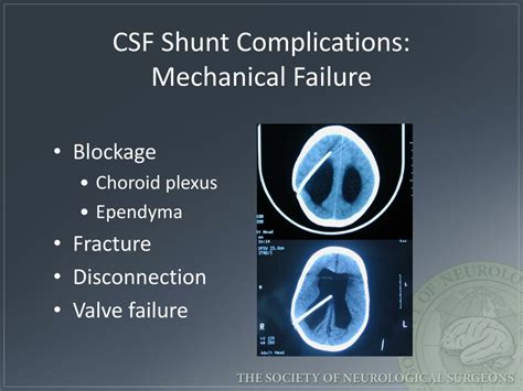 PPT - Emergency Evaluation of Hydrocephalus Shunt Patients PowerPoint Presentation - ID:2079100