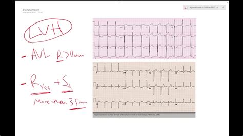 LVH on ECG (Left ventricular hypertrophy) - Learn ECG! - Dr Jamal USMLE ...