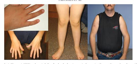 Figure 2 from A new look at XXYY syndrome: medical and psychological features. | Semantic Scholar