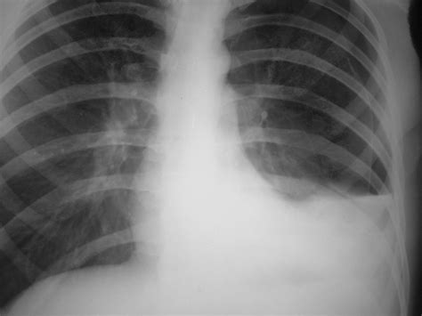 Hydropneumothorax – CXR - Radiology at St. Vincent's University Hospital