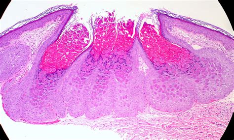 Molluscum Contagiosum — Ophthalmology Review