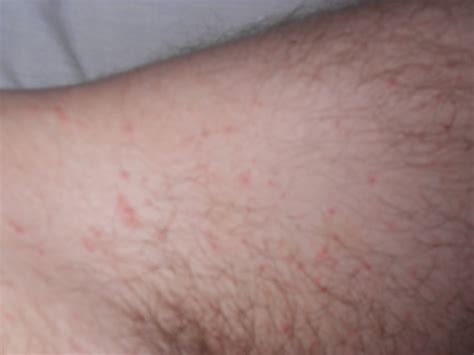 Is Your Scabies Worse After Treatment? | HubPages