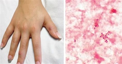 Woman develops gonorrhea rash on her hands and all over her skin ...