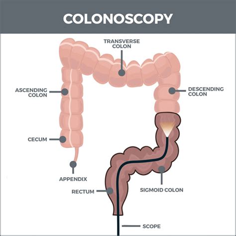 Colonoscopy | Gastro MD