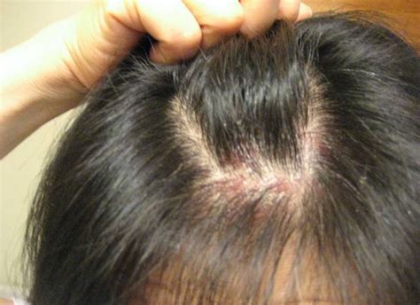 Would Any Stage of Scalp Psoriasis Cause Hair Loss? - MyRujukan