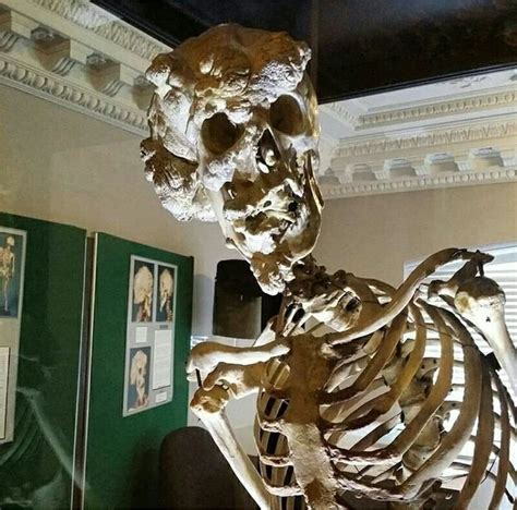 The real skeleton of Joseph Merrick aka The Elephant Man. Photo by ...