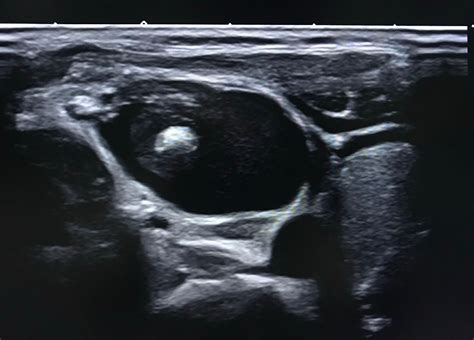 VIETNAMESE MEDIC ULTRASOUND: CASE 552: ULTRASOUND OF A CYSTIC NECK MASS, Dr PHAN THANH HAI ...