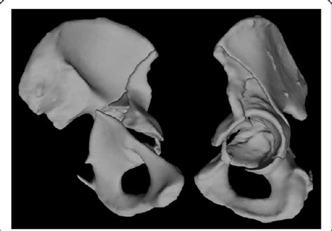 Case 6-model of the left hemipelvis on the day of admission shows a... | Download Scientific Diagram