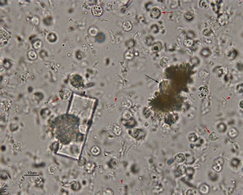 Urine crystals | eClinpath