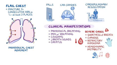 Flail chest: Nursing - Osmosis Video Library