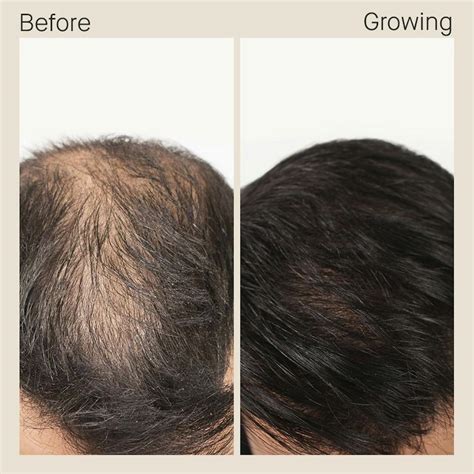 These Men Transformed Their Hair With Nutrafol | Nutrafol