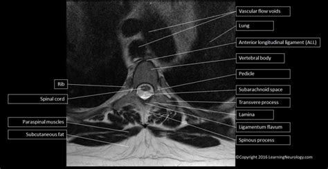 Approach to MRI Spine | LearningNeurology.com