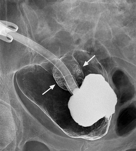 Normal double contrast fluoroscopic appearance of the Kock (K) pouch.... | Download Scientific ...