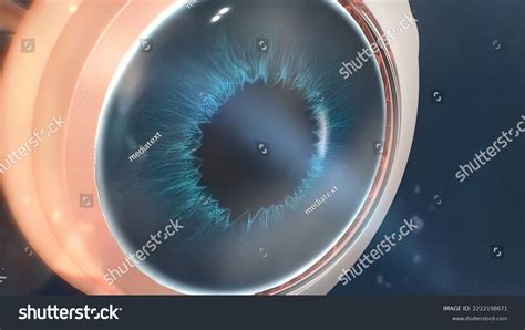 Uveitis Inflammation Part All Uvea Eye Stock Illustration 2222198671 ...