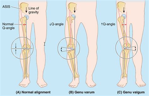 Patellar dislocation causes, symptoms, diagnosis, treatment & prognosis