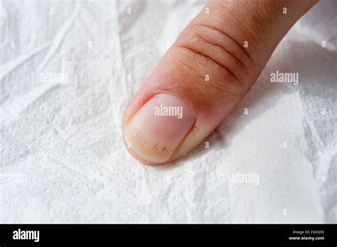 Splinter Haemorrhage : multiple splinter haemorrhages appear on a Stock Photo, Royalty Free ...