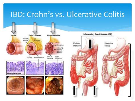 PPT - Nutritional Management of Crohn’s Disease PowerPoint Presentation ...