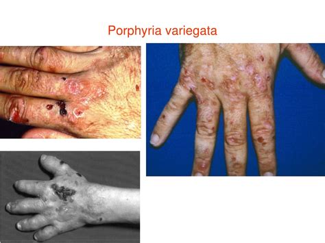 PPT - The classification of porphyria PowerPoint Presentation, free ...